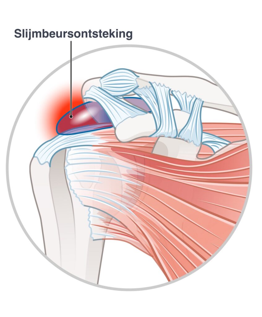 slijmbeursontsteking